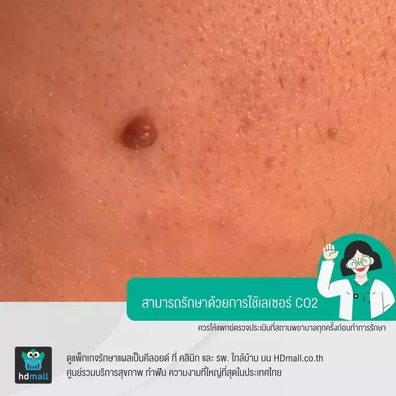 แผลคีลอยด์ที่เหมาะกับการใช้เลเซอร์รักษาแผลเป็นคีลอยด์