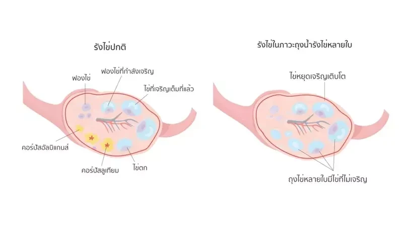 เปรียบเทียบภาวะถุงน้ำรังไข่หลายใบ กับอาการถุงน้ำรังไข่บกพร่อง โดย Yesmom