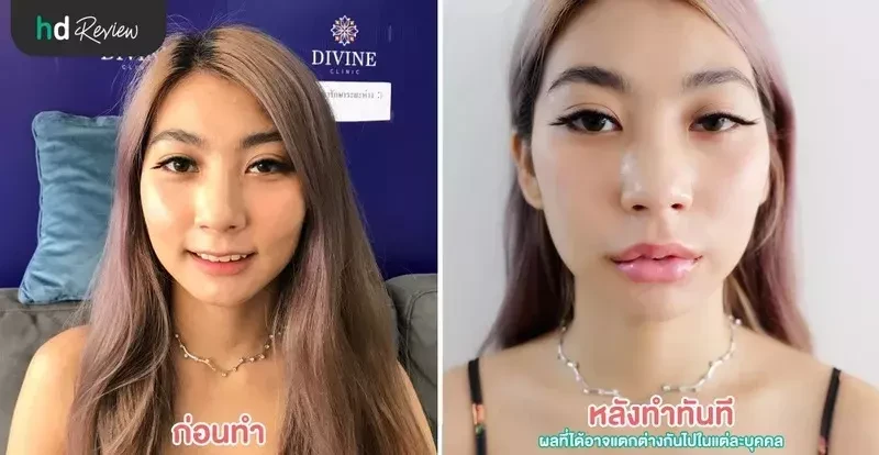 ภาพเปรียบเทียบก่อนทำและหลังทำทันที