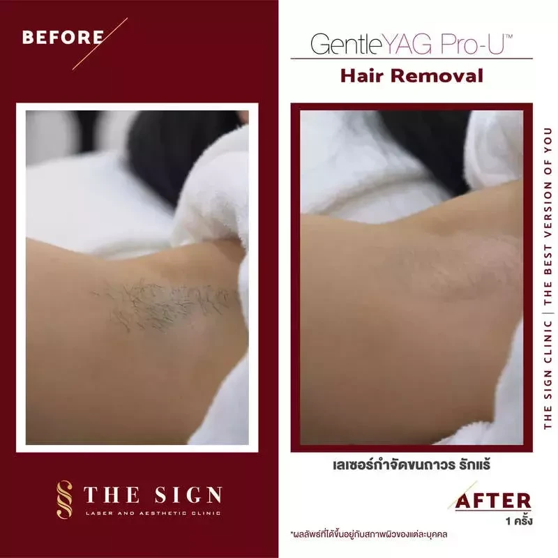 Before After GentleYag Pro-U เลเซอร์กำจัดขนถาวรที่เดอะไซน์ คลินิก (The Sign Clinic)