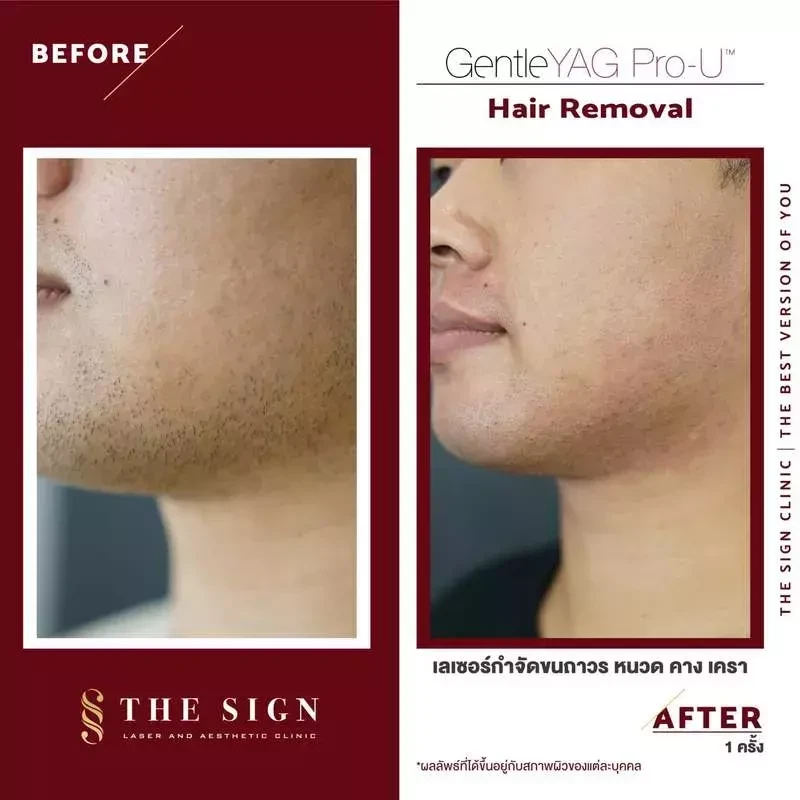GentleYag Pro-U เลเซอร์กำจัดขนถาวรที่เดอะไซน์ คลินิก (The Sign Clinic)