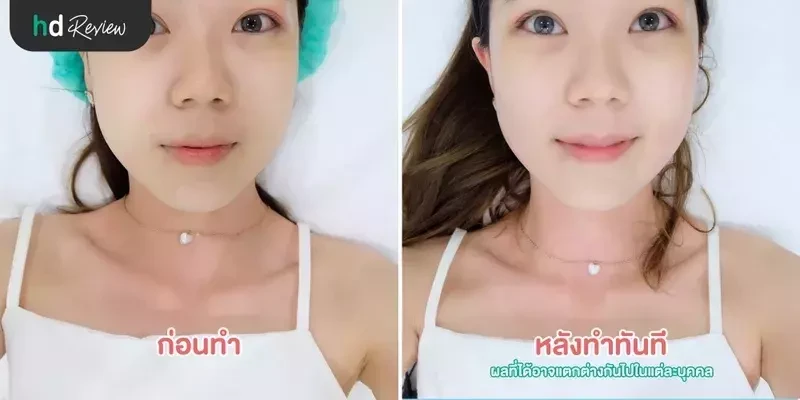 ภาพเปรียบเทียบก่อนทำและหลังทำทันที