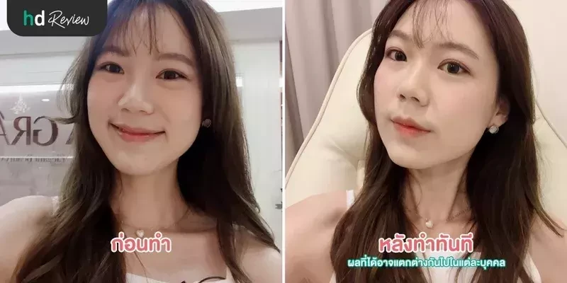 ภาพเปรียบเทียบก่อนทำและหลังทำทันที