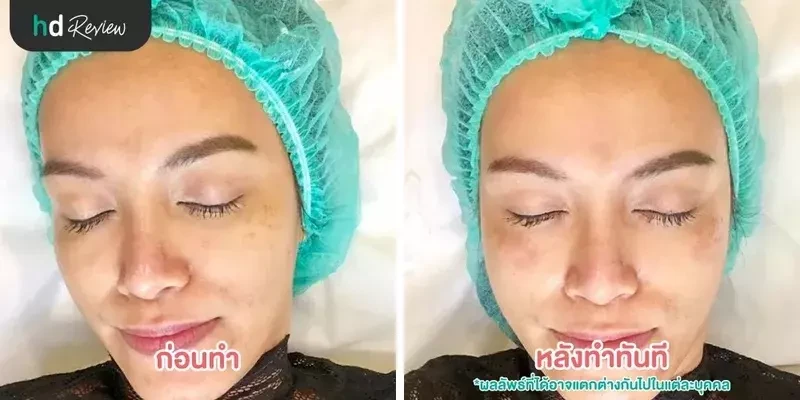 ภาพเปรียบเทียบก่อนทำและหลังทำทันที