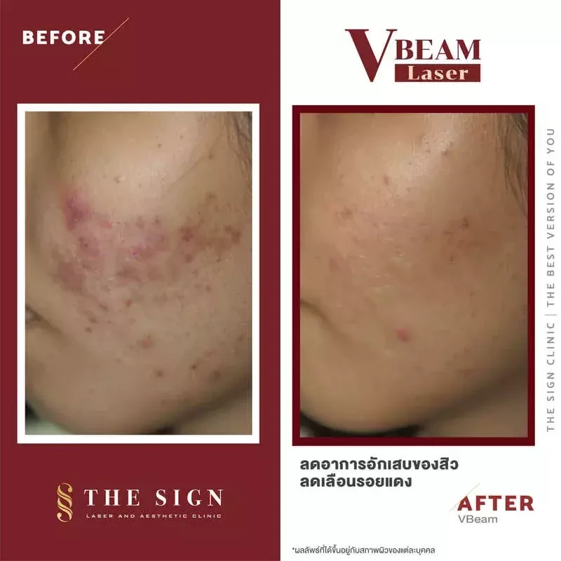 รีวิว Vbeam รักษาสิว สิวอักเสบ รอยแดงสิว รอยเส้นเลือดขยายบนใบหน้า และแก้ปัญหาเส้นเลือดขอดที่เดอะไซน์ คลินิก (The Sign Clinic)
