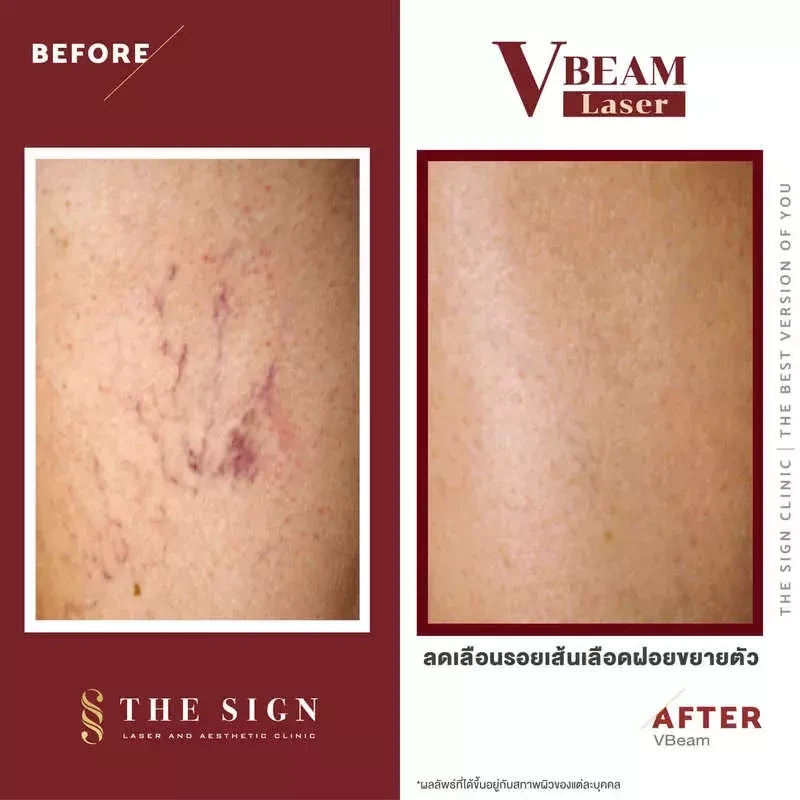 รีวิว Vbeam รักษาสิว สิวอักเสบ รอยแดงสิว รอยเส้นเลือดขยายบนใบหน้า และแก้ปัญหาเส้นเลือดขอดที่เดอะไซน์ คลินิก (The Sign Clinic)