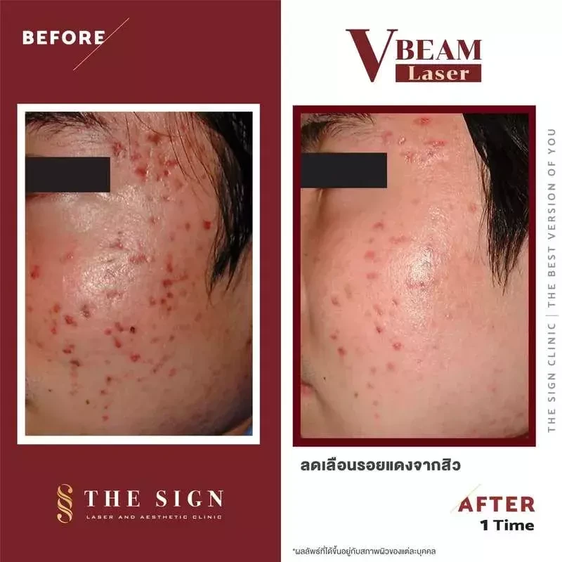 รีวิว Vbeam รักษาสิว สิวอักเสบ รอยแดงสิว รอยเส้นเลือดขยายบนใบหน้า และแก้ปัญหาเส้นเลือดขอดที่เดอะไซน์ คลินิก (The Sign Clinic)