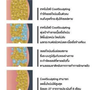 รีวิว CoolSculpting สลายไขมันถาวร ปรับหุ่นลดสัดส่วนโดยไม่ต้องผ่าตัด ที่เดอะไซน์ คลินิก (The Sign Clinic) 4 content coolsculpting 200602 0002