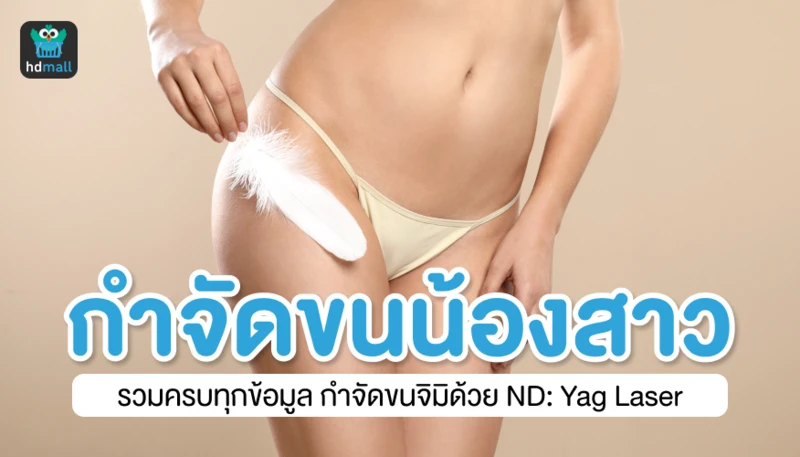กำจัดขนน้องสาวด้วย Nd:YAG Laser