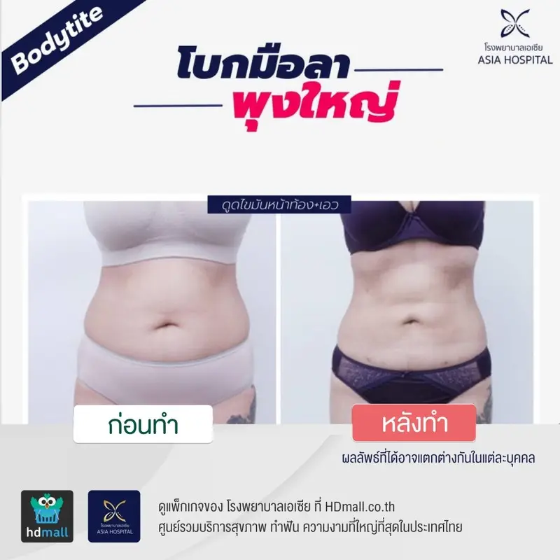 รีวิว ดูดไขมันท้อง ที่ โรงพยาบาลเอเซีย