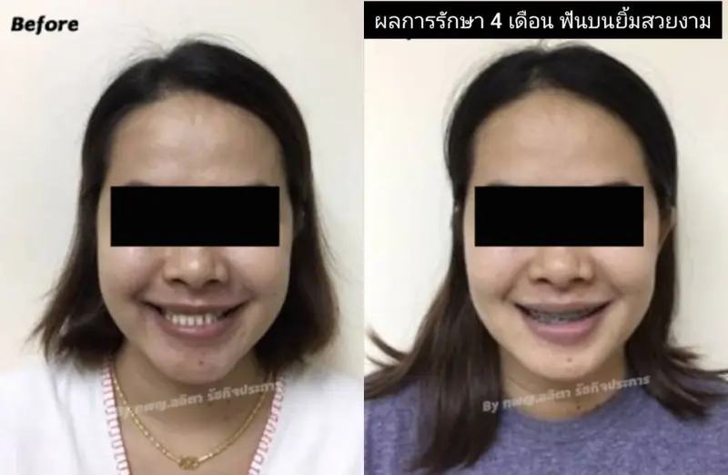 รีวิวจัดฟันแก้ฟันเหยิน ที่ คลินิกฟันยิ้ม ราม 2