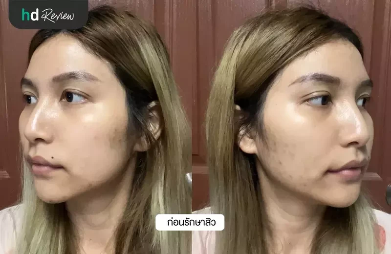 ผู้ใช้บริการก่อนรักษาสิว