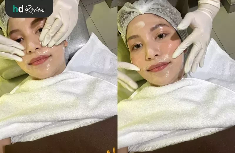 ขั้นตอนการรักษาสิว ด้วยโปรแกรม AC Clear II (กด ฉีด ทรีตเมนต์ เลเซอร์) ที่ Romrawin Clinic