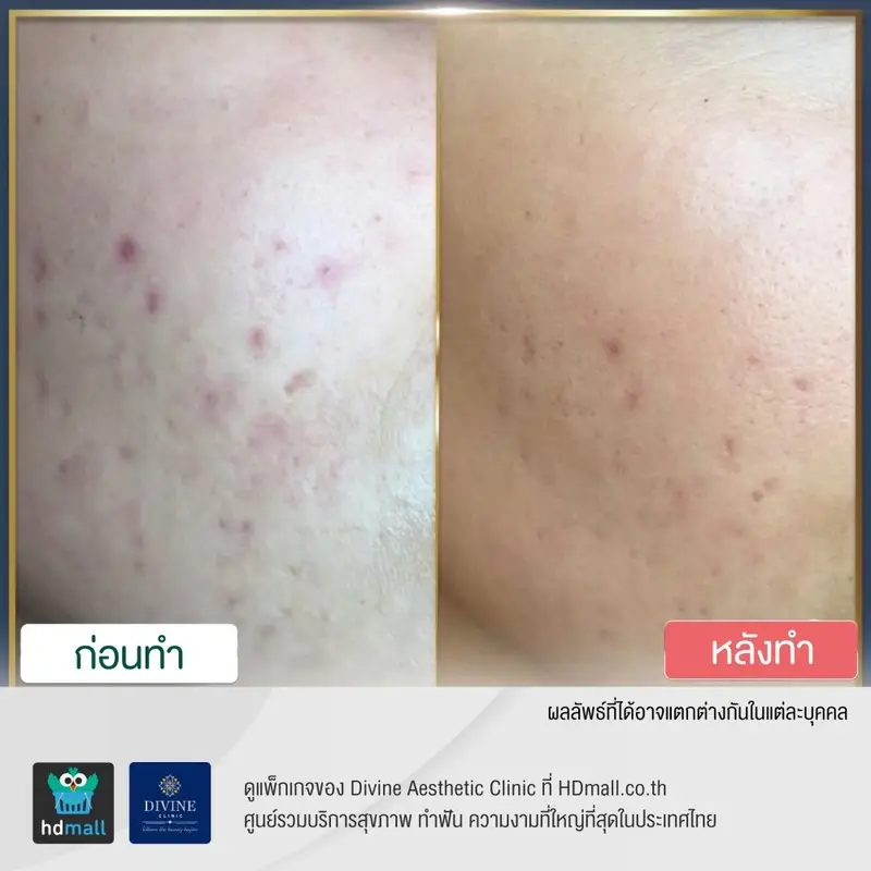 รีวิว ลดรอยสิว ที่ Divine Aesthetic Clinic