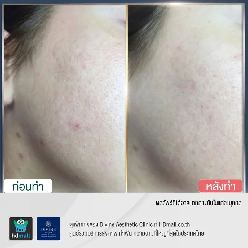 รีวิว ลดรอยสิว ที่ Divine Aesthetic Clinic