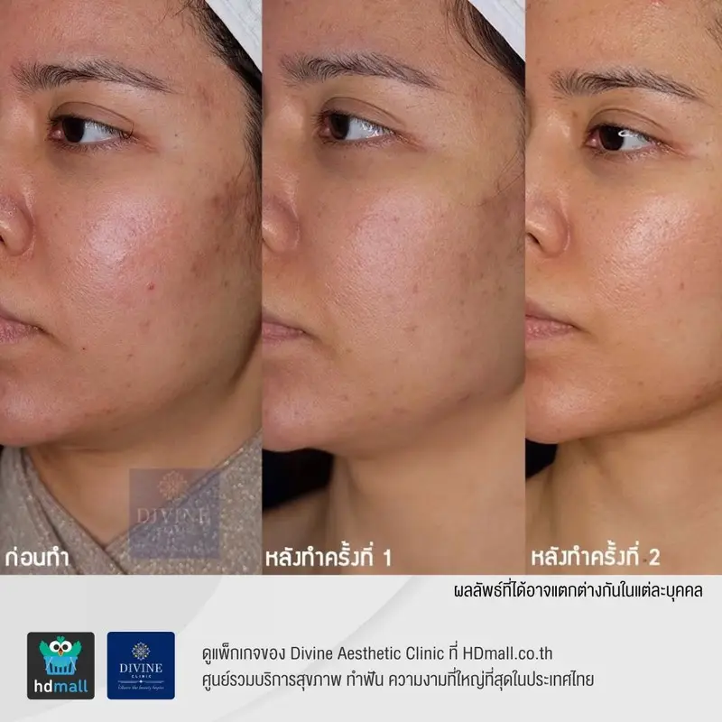 รีวิว ลดรอยสิว ที่ Divine Aesthetic Clinic