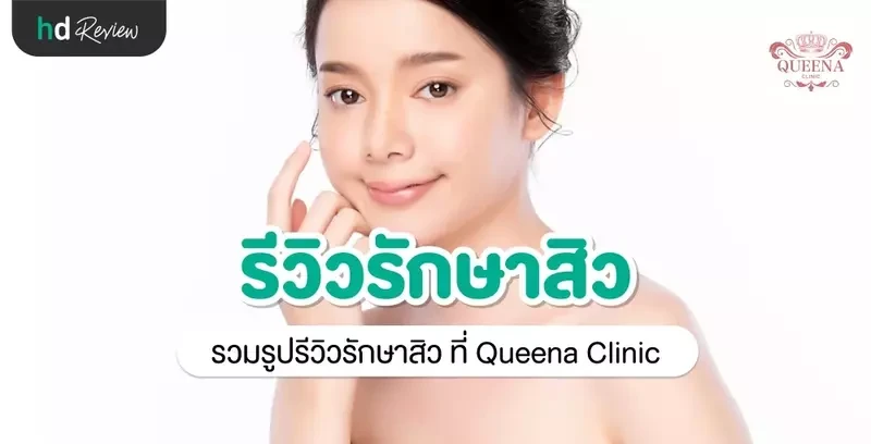 รีวิว รักษาสิว ที่ Queena Clinic