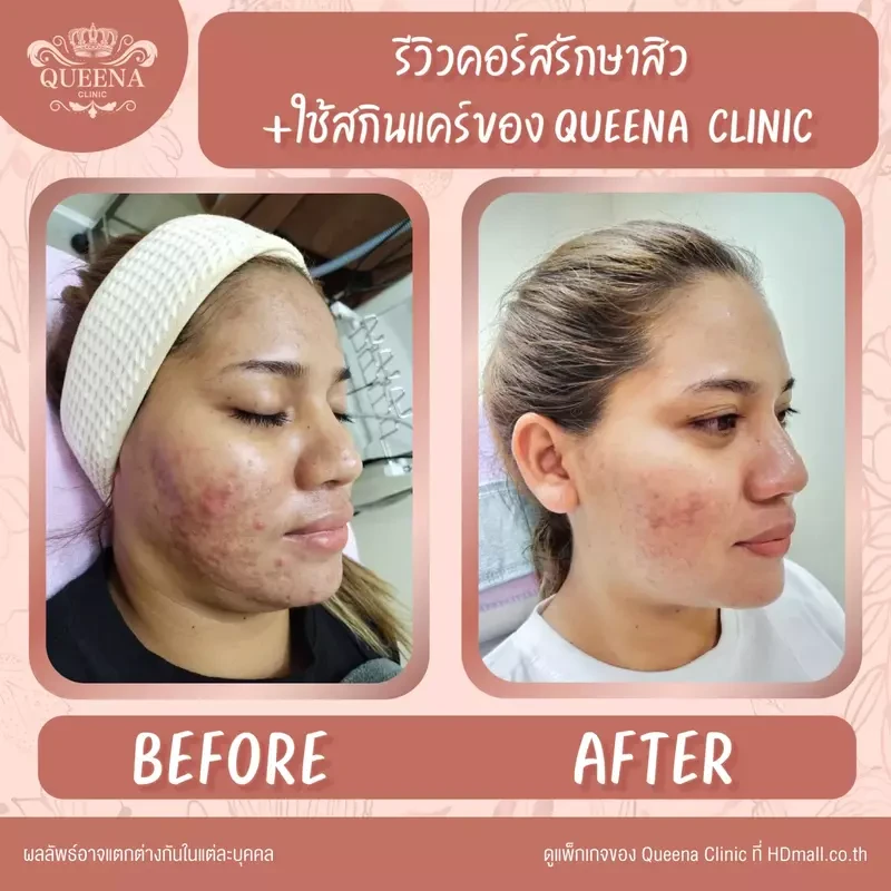 รีวิว รักษาสิว ที่ Queena Clinic 3 รีวิว รักษาสิว ที่ Queena Clinic