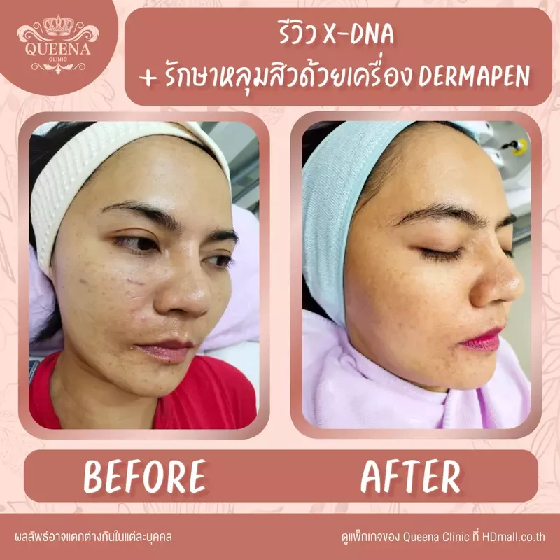 รีวิว รักษาสิว ที่ Queena Clinic