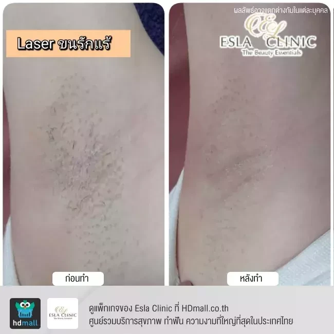 รีวิว กำจัดขนรักแร้ ด้วยเลเซอร์ E-light ที่ Esla Clinic