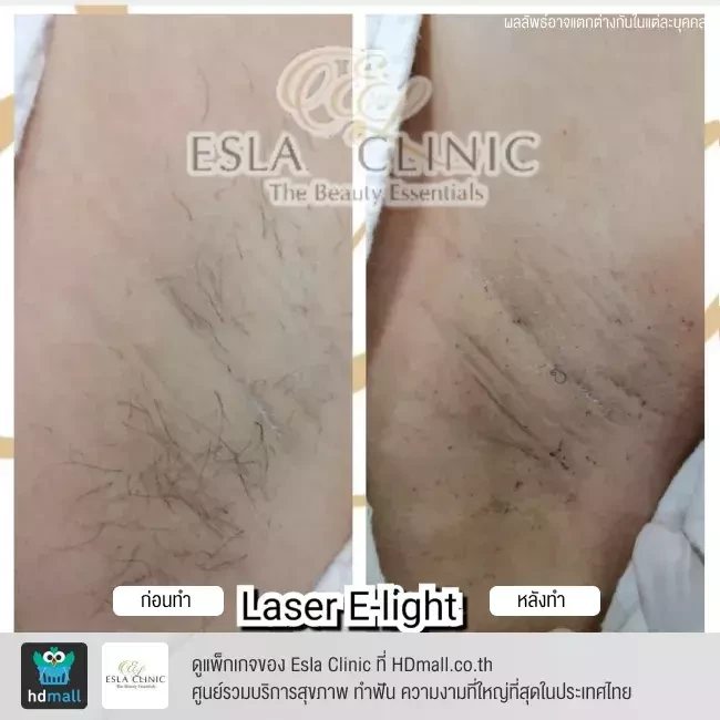 รีวิว กำจัดขนรักแร้ ด้วยเลเซอร์ E-light ที่ Esla Clinic