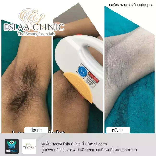 รีวิว กำจัดขนรักแร้ ด้วยเลเซอร์ E-light ที่ Esla Clinic