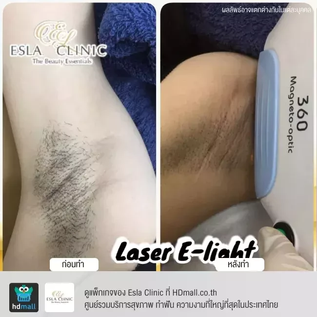 รีวิว กำจัดขนรักแร้ ด้วยเลเซอร์ E-light ที่ Esla Clinic