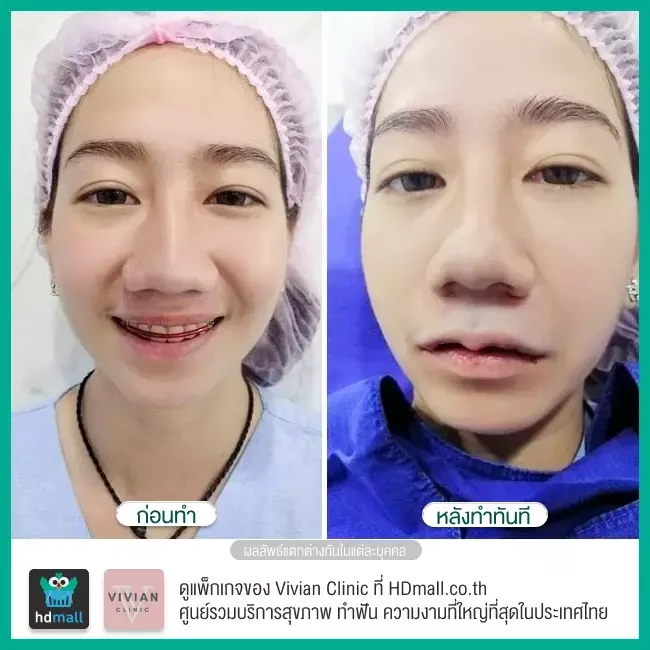 Before After รีวิว ศัลยกรรมปากกระจับ ที่ Vivian Clinic