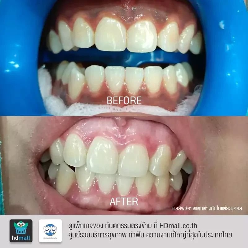รีวิว ฟอกสีเหงือก ที่ ทันตกรรมตรงข้าม