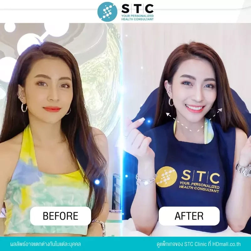 รีวิว ฉีดโบท็อกซ์ ที่ STC Clinic