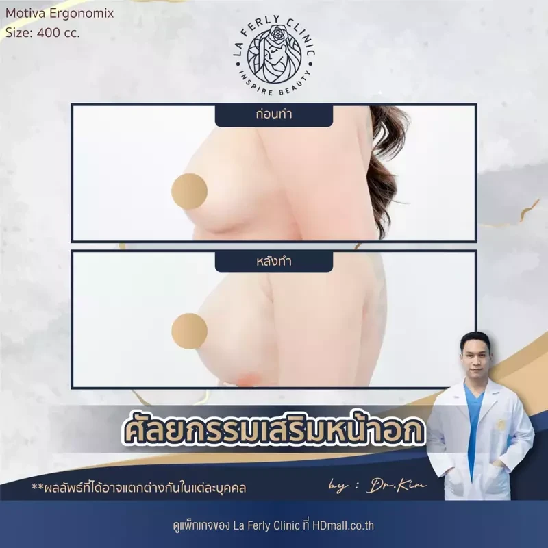 รีวิว เสริมหน้าอก ที่ La Ferly Clinic