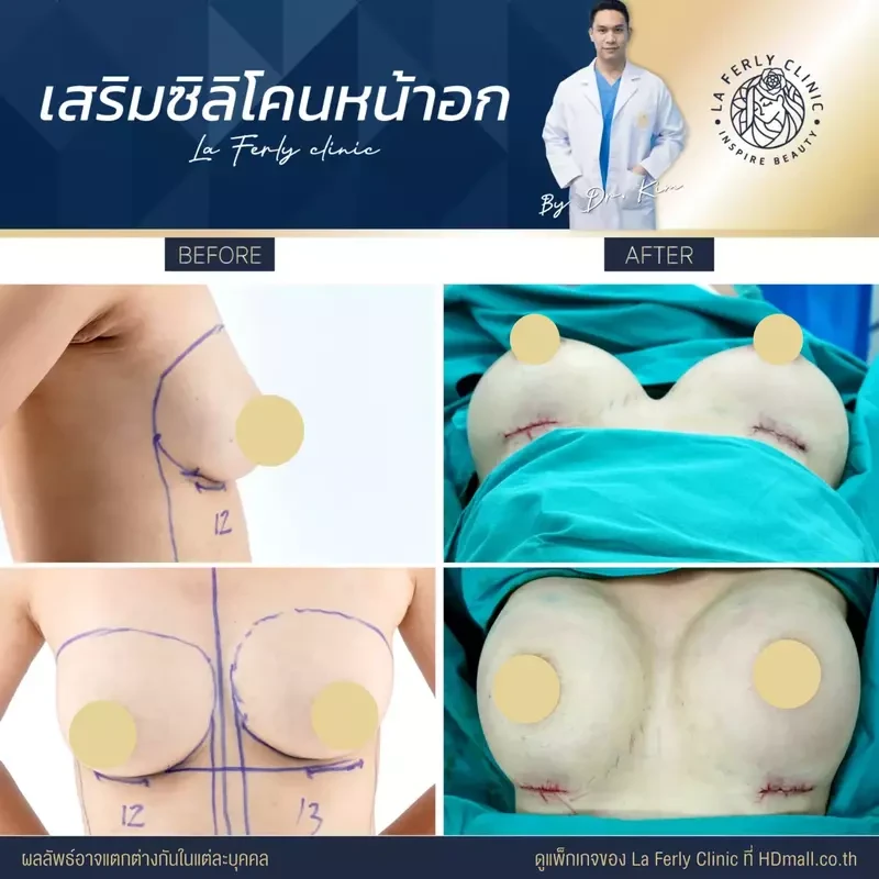 รีวิว เสริมหน้าอก ที่ La Ferly Clinic