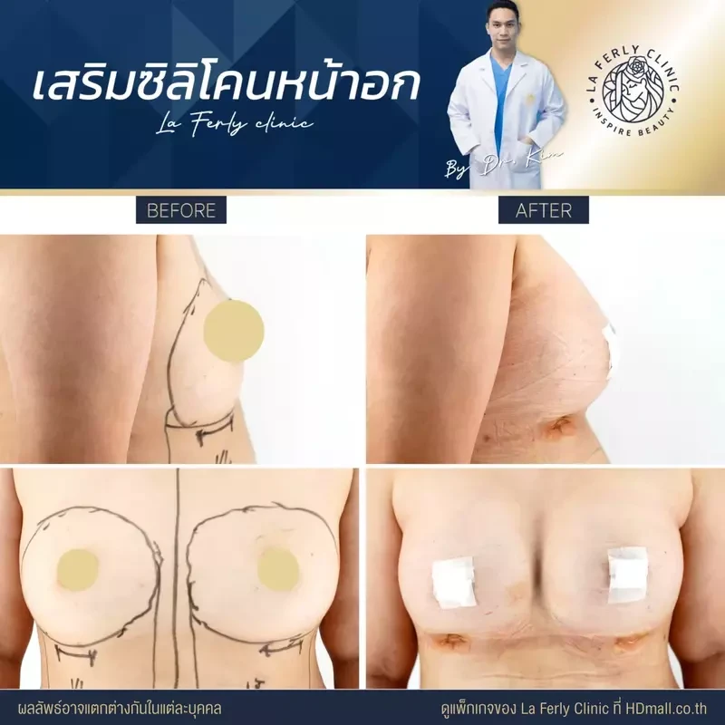 รีวิว เสริมหน้าอก ที่ La Ferly Clinic