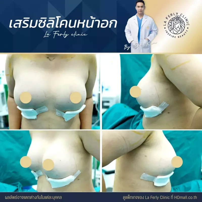 รีวิว เสริมหน้าอก ที่ La Ferly Clinic