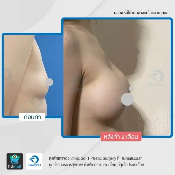 รวมรูปรีวิว เสริมหน้าอก แบบส่องกล้อง Endoscopic ที่ Clinic Soi 1 Plastic Surgery