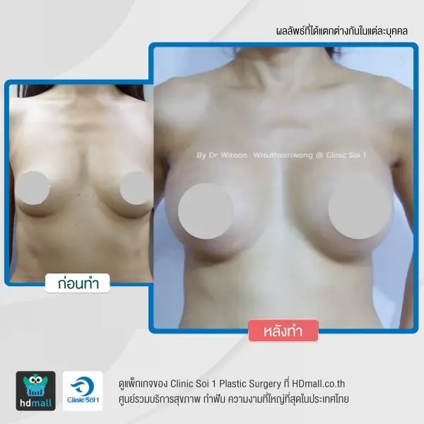 รวมรูปรีวิว เสริมหน้าอก แบบส่องกล้อง Endoscopic ที่ Clinic Soi 1 Plastic Surgery