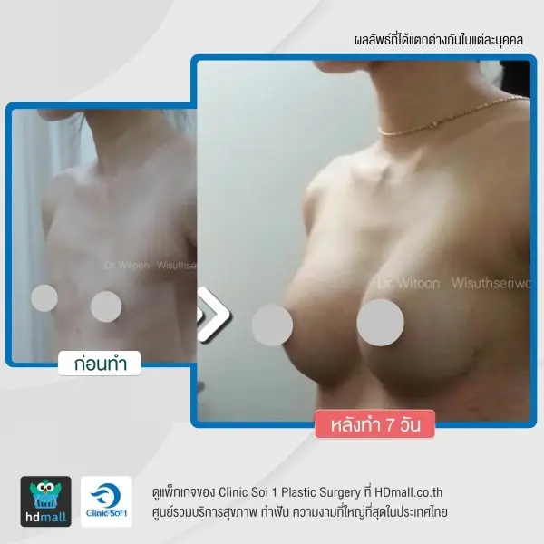 รวมรูปรีวิว เสริมหน้าอก แบบส่องกล้อง Endoscopic ที่ Clinic Soi 1 Plastic Surgery