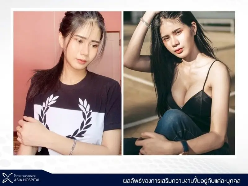 ภาพเปรียบเทียบ Before-After เสริมหน้าอก ที่โรงพยาบาลเอเชีย