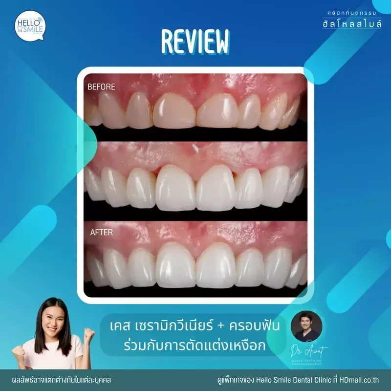 รีวิว ทำวีเนียร์ เซรามิก ที่ Hello Smile Dental Clinic