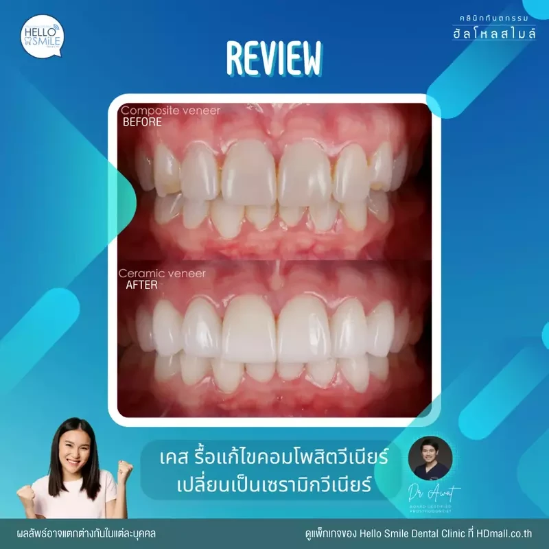 รีวิว ทำวีเนียร์ เซรามิก ที่ Hello Smile Dental Clinic