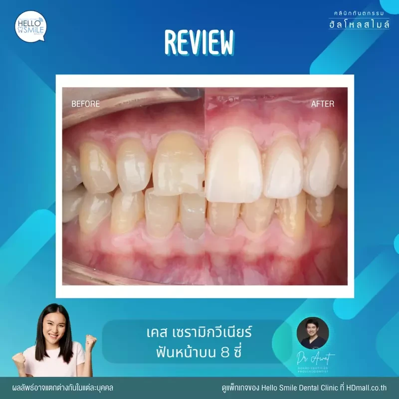 รีวิว ทำวีเนียร์ เซรามิก ที่ Hello Smile Dental Clinic