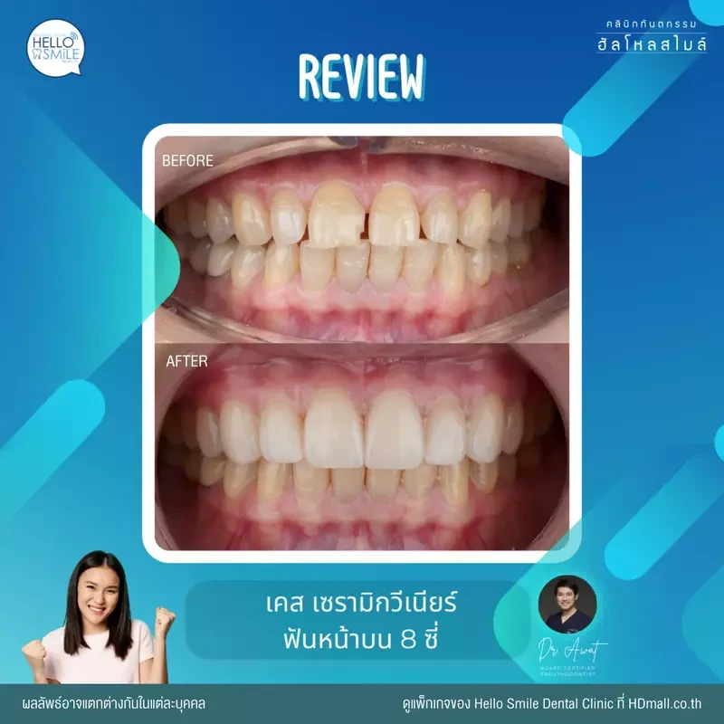 รีวิว ทำวีเนียร์ เซรามิก ที่ Hello Smile Dental Clinic