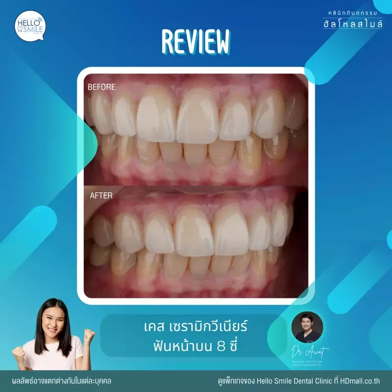 รีวิว ทำวีเนียร์ เซรามิก ที่ Hello Smile Dental Clinic