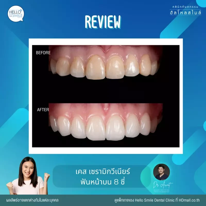รีวิว ทำวีเนียร์ เซรามิก ที่ Hello Smile Dental Clinic