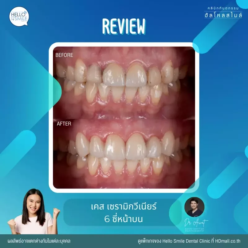 รีวิว ทำวีเนียร์ เซรามิก ที่ Hello Smile Dental Clinic