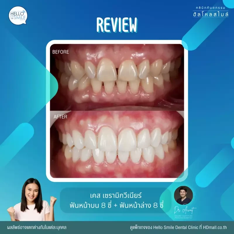 รีวิว ทำวีเนียร์ เซรามิก ที่ Hello Smile Dental Clinic