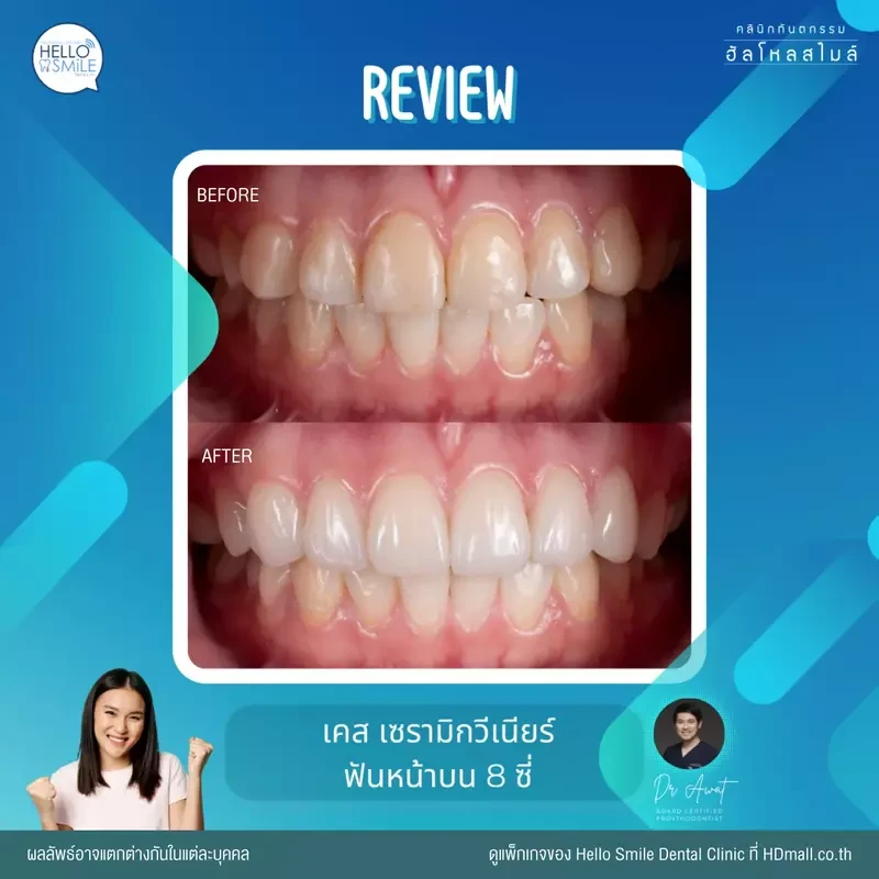 รีวิว ทำวีเนียร์ เซรามิก ที่ Hello Smile Dental Clinic