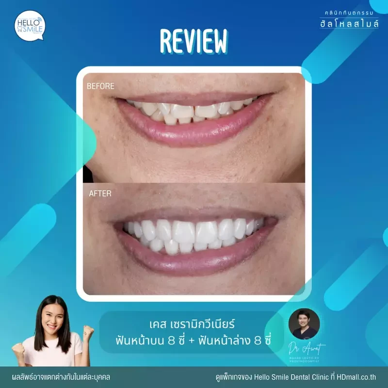 รีวิว ทำวีเนียร์ เซรามิก ที่ Hello Smile Dental Clinic