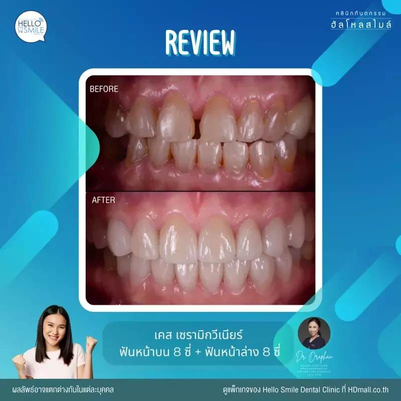 รีวิว ทำวีเนียร์ เซรามิก ที่ Hello Smile Dental Clinic