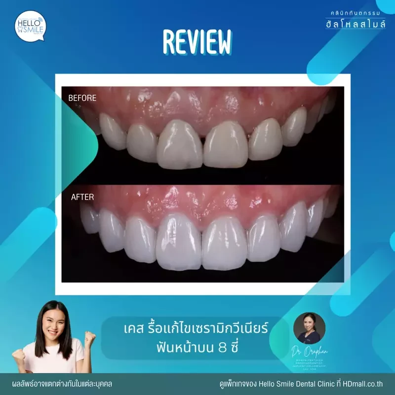รีวิว ทำวีเนียร์ เซรามิก ที่ Hello Smile Dental Clinic